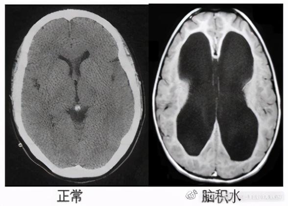 头里积水的秘密